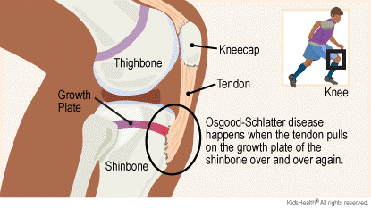 bagaimana osgood schlatter