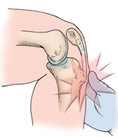 penyakit Osgood-Schlatter