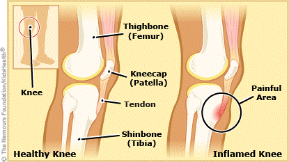 punca Osgood-Schlatter